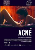 痤疮Acné (2007)